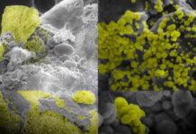 Científicos encontraron bacterias vivas… literalmente dentro de los cálculos renales. Científicos encontraron bacterias vivas… literalmente dentro de los cálculos renales.