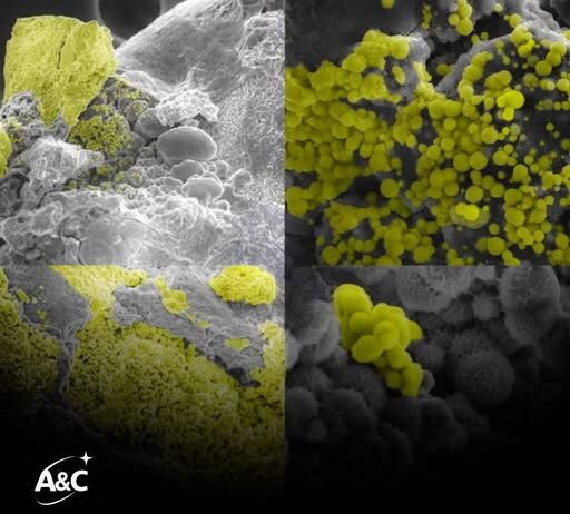 Científicos encontraron bacterias vivas… literalmente dentro de los cálculos renales. Científicos encontraron bacterias vivas… literalmente dentro de los cálculos renales.